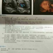 右肾分离的胎儿是男孩（右肾分离的胎儿是男孩）