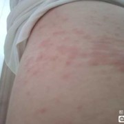 过敏对胎儿有影响吗（孕妇吃虾过敏对胎儿有影响吗）