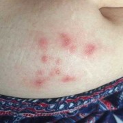 孕期疱疹对胎儿的影响（孕妇得了带状疱疹会不会影响胎儿）
