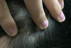 怎么从怀孕了就有头皮屑了，一块一块的,孕期有头皮屑怎么回事