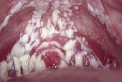 孕期阴道炎的症状（孕妇尿完尿一擦黄绿色分泌物）