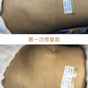 怀孕期间妊娠纹去除（孕妇肚子的妊娠纹怎么消除）