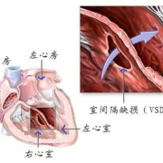 胎儿房缺（胎儿房缺室缺能留下来吗）