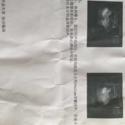 怀孕早期胎心胎芽出现的晚是什么原因造成的,胎心出现晚的孩子健康吗