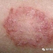 皮肤病会影响胎儿吗（皮肤病会影响胎儿吗）
