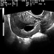 子宫肌瘤中CDFI:周边可见带状血流信号,孕妇宫腔内带状分隔