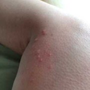 孕期腿上长疙瘩特别痒（孕期身上长小包，并且痒）