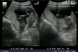 怀孕四个月胎儿彩超（怀孕四个月肚子疼的厉害怎么回事）