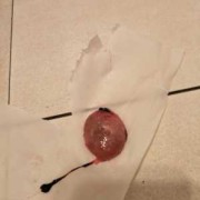 胎儿停止发育是什么原因造成的（怀孕10周胎儿停止发育应该怎么办）