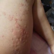 荨麻疹怀孕影响胎儿吗（孕妇身上起风团对胎儿有影响吗）