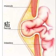 胎儿膈疝是什么（生理性中肠疝是什么疾病）