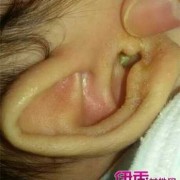 十个月宝宝中耳炎是什么症状,孕妇中耳炎会影响胎儿吗视频