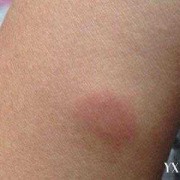 孕期青霉素（大家知道孕妇为什么会对青霉素过敏呢）