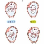 胎儿颈后见脐反射（胎儿颈后见脐反射呈U型）