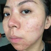 美业挤痘违法么？算破皮吗,孕期挤痘痘对胎宝宝有影响吗图片