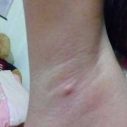 怀孕后腋下长了个小疙瘩怎么回事,孕期腋下有疙瘩是怎么回事