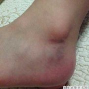 孕期脚淤（孕期脚淤青怎么办）
