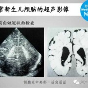 胎儿彩超头部（新生儿头颅彩超能检查出什么病）