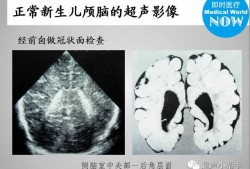 胎儿彩超头部（新生儿头颅彩超能检查出什么病）