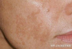 孕期皮肤变黑怎么回事（孕期皮肤变黑怎么回事儿）