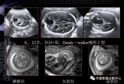 胎儿脑磁共振（胎儿脑磁共振检查对小孩有影响吗）