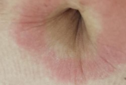 孕期腹部痒（孕期腹部痒怎么回事）