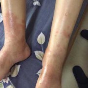 孕期皮肤病怎么治疗（孕期皮肤病怎么治疗最好）