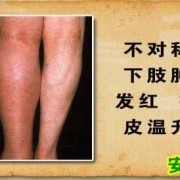 孕期腿血栓图片（孕期腿血栓图片）