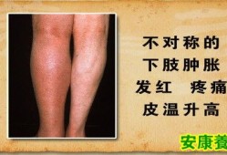 孕期腿血栓图片（孕期腿血栓图片）