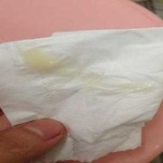 孕期白带是什么样的（正常孕妇分泌物图片）