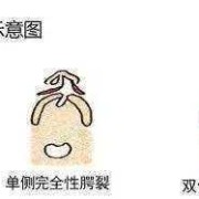 胎儿唇腭裂的原因（胎儿唇腭裂的原因跟男方有关吗）