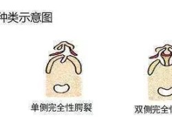 胎儿唇腭裂的原因（胎儿唇腭裂的原因跟男方有关吗）