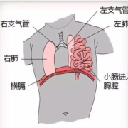 胎儿膈疝是什么（生理性中肠疝是什么疾病）