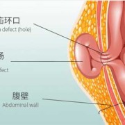 孕期疝气（孕期疝气需要注意什么）