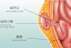 孕期疝气（孕期疝气需要注意什么）