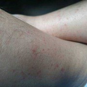 孕期小腿发红（孕期小腿发红不痛不痒）