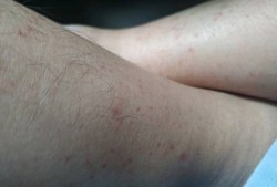 孕期小腿发红（孕期小腿发红不痛不痒）