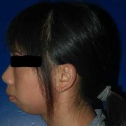 宝宝下颚有点突出怎么办,胎儿下颌小必须引产吗