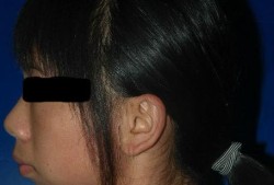 宝宝下颚有点突出怎么办,胎儿下颌小必须引产吗