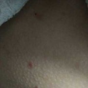 治疗孕期疣（孕七个月胸上长类似扁平疣的东西怎么办）