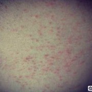 孕期身上长小红点（孕期身上起小红点，很痒怎么办）