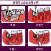 怀孕期间能不能拔牙,备孕期能拔牙吗智齿
