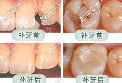 孕期能补牙（孕期能补牙）
