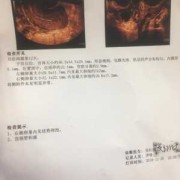 孕期宫内积液（孕期出血宫腔有激液怎么办）