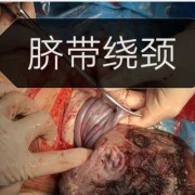 胎儿脐带短（胎儿脐带短是什么原因造成的）