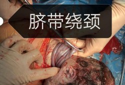 胎儿脐带短（胎儿脐带短是什么原因造成的）
