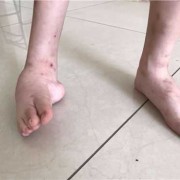 新生儿轻微脚内翻是怎么回事呢,孕期足内翻出生以后有正常的吗