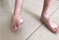 新生儿轻微脚内翻是怎么回事呢,孕期足内翻出生以后有正常的吗