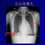 胎儿右心房增大的原因（左心房增大，怎么回事）