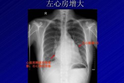 胎儿右心房增大的原因（左心房增大，怎么回事）